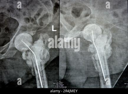 L'articulation de la hanche à rayons X simple montre une fracture cervicale trans gauche de la tête du fémur avec un chargeur d'antibiotiques temporaire, un ciment osseux chargé d'antibiotiques à l'arrière Banque D'Images