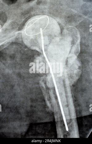 L'articulation de la hanche à rayons X simple montre une fracture cervicale trans gauche de la tête du fémur avec un chargeur d'antibiotiques temporaire, un ciment osseux chargé d'antibiotiques à l'arrière Banque D'Images