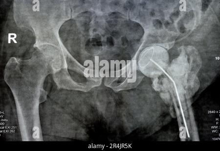 L'articulation de la hanche à rayons X simple montre une fracture cervicale trans gauche de la tête du fémur avec un chargeur d'antibiotiques temporaire, un ciment osseux chargé d'antibiotiques à l'arrière Banque D'Images