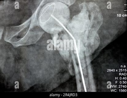 L'articulation de la hanche à rayons X simple montre une fracture cervicale trans gauche de la tête du fémur avec un chargeur d'antibiotiques temporaire, un ciment osseux chargé d'antibiotiques à l'arrière Banque D'Images