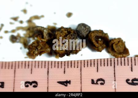 Néphrolithiase, calculs rénaux bruns irréguliers (calculs rénaux ou néphrolithes), les calculs sont de taille différente après urétéroscopie opérative et laser Banque D'Images