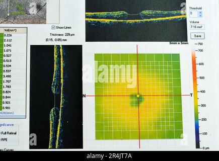 OCT de l'œil révèle une membrane épimaculaire faible et un trou maculaire pleine épaisseur impliquant la fovéa, entourant l'œdème maculaire diffus montrant peu de c Banque D'Images