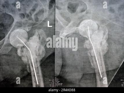 L'articulation de la hanche à rayons X simple montre une fracture cervicale trans gauche de la tête du fémur avec un chargeur d'antibiotiques temporaire, un ciment osseux chargé d'antibiotiques à l'arrière Banque D'Images