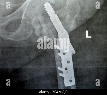 Col cervical trans de la hanche gauche de la fracture du fémur fixé par DHS Dynamic Hip Screw, PXR à rayons X simple d'un ancien patient, un orthopédique épargnant la tête fémorale Banque D'Images