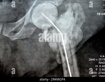 L'articulation de la hanche à rayons X simple montre une fracture cervicale trans gauche de la tête du fémur avec un chargeur d'antibiotiques temporaire, un ciment osseux chargé d'antibiotiques à l'arrière Banque D'Images
