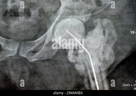 L'articulation de la hanche à rayons X simple montre une fracture cervicale trans gauche de la tête du fémur avec un chargeur d'antibiotiques temporaire, un ciment osseux chargé d'antibiotiques à l'arrière Banque D'Images