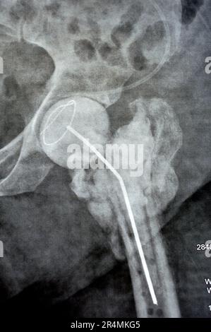L'articulation de la hanche à rayons X simple montre une fracture cervicale trans gauche de la tête du fémur avec un chargeur d'antibiotiques temporaire, un ciment osseux chargé d'antibiotiques à l'arrière Banque D'Images