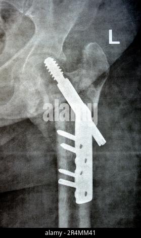 Col cervical trans de la hanche gauche de la fracture du fémur fixé par DHS Dynamic Hip Screw, PXR à rayons X simple d'un ancien patient, un orthopédique épargnant la tête fémorale Banque D'Images