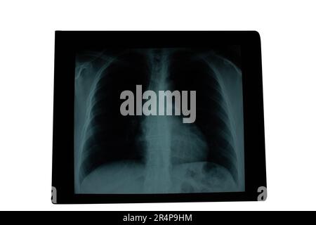 Radiographie post-thoracique antérieure montrant le parenchyme pulmonaire avec un schéma radiographique homogène et une proéminence du bouton aortique chez le patient Banque D'Images