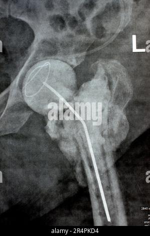 L'articulation de la hanche à rayons X simple montre une fracture cervicale trans gauche de la tête du fémur avec un chargeur d'antibiotiques temporaire, un ciment osseux chargé d'antibiotiques à l'arrière Banque D'Images