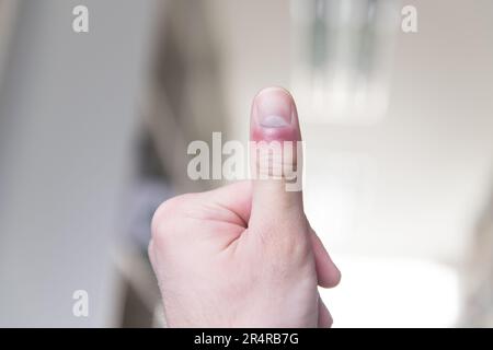 Homme souffrant de la main et du doigt dans Pain​ avec surlignage rouge Banque D'Images