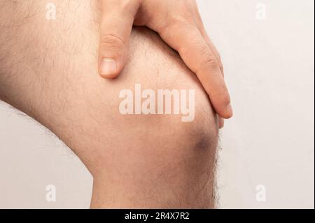 Bleu ecchymose sur la jambe du genou macro clsoe vue vers le haut isolé Banque D'Images