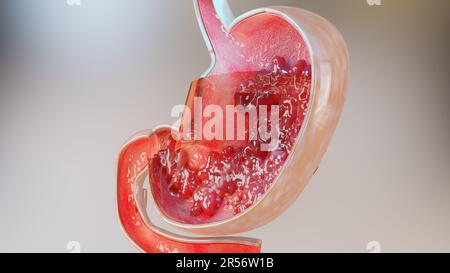 Cancer de l'estomac. Stades de la croissance tumorale dans le système digestif, ulcère peptique, cancer attaquant la cellule. concept de maladie gastrique. symptômes, cancéreux malins, Banque D'Images