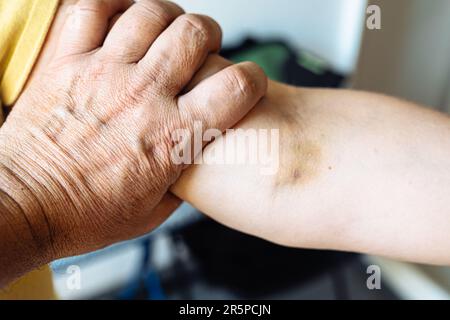 Ecchymose sur le bras à la suite de l'injection. Banque D'Images