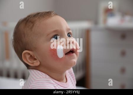 Mignon petit bébé avec de la crème anti-allergique sur ses joues à la maison, gros plan et espace pour le texte. Rougeur de la peau Banque D'Images