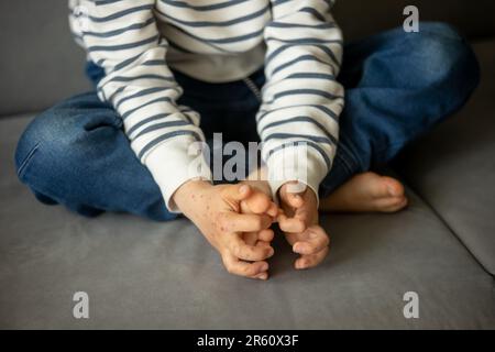 Enfant avec une éruption cutanée, roséola, maladie main-pied-et-bouche, maladie de l'éruption cutanée de l'enfant Banque D'Images