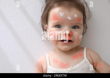 Mignon petit bébé avec de la crème anti-allergique sur son visage dans un berceau, vue du dessus et espace pour le texte. Rougeur de la peau Banque D'Images