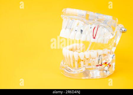 Modèle dentaire transparent avec implant dentaire sur fond jaune. Banque D'Images