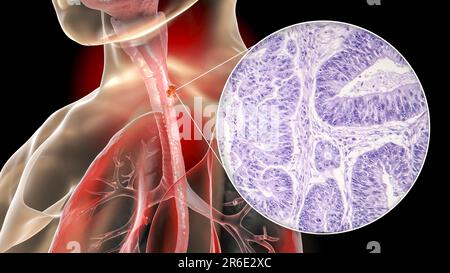 Cancer de l'œsophage, illustration informatique composite. Des cancers comme celui-ci peuvent entraîner des difficultés à avaler. Le cancer de l'œsophage n'est généralement pas un déte Banque D'Images