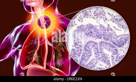 Cancer de l'œsophage, illustration informatique composite. Des cancers comme celui-ci peuvent entraîner des difficultés à avaler. Le cancer de l'œsophage n'est généralement pas un déte Banque D'Images