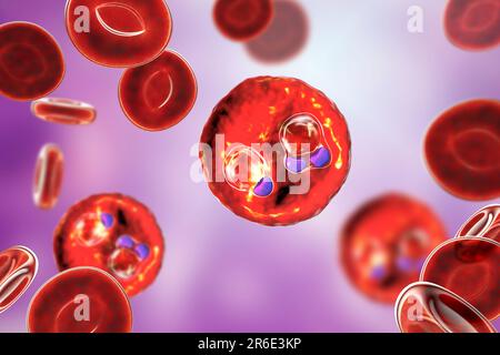 Protozoaire Plasmodium falciparum à l'intérieur des globules rouges, illustration informatique. P. falciparum est l'agent causal du paludisme Tertien malin, également connu Banque D'Images