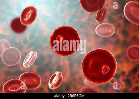 Protozoaire Plasmodium malariae à l'intérieur des globules rouges, illustration informatique. P. malariae est l'agent causal du Quartan Malaria, également connu sous le nom de malarique M. Banque D'Images