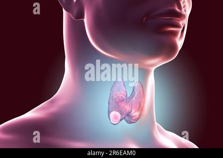 Tumeur dans la glande thyroïde humaine, illustration informatique. Banque D'Images