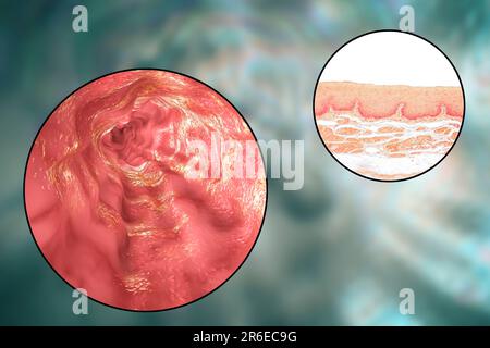 La paroi de l'œsophage. Microphotographie lumière d'une section à travers l'œsophage humain, qui passe les aliments de la bouche à l'estomac. L'oesophage lumen (wh Banque D'Images