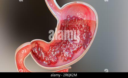 Cancer de l'estomac. Stades de la croissance tumorale dans le système digestif, ulcère peptique, cancer attaquant la cellule. concept de maladie gastrique. symptômes, cancéreux malins, Banque D'Images