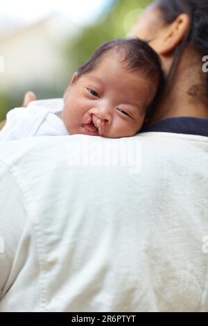 Portrait, fente du palais et de bébé avec la santé, les soins et de câlin avec la mère, se détendre et se lier ensemble. Visage, maman et bébé heureux embrasser, médical Banque D'Images