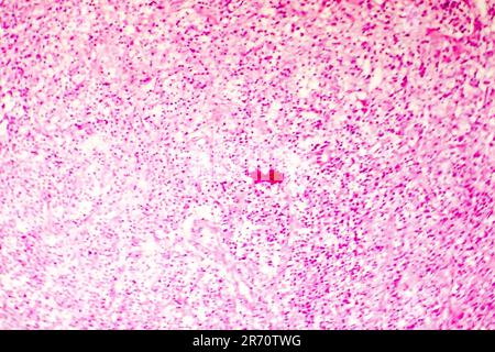 Nécrose liquefactive du cerveau humain, photomicrographe lumineux montrant la perte des contours cellulaires, l'accumulation de débris cellulaires, macrophages infiltratio Banque D'Images