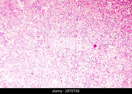 Nécrose liquefactive du cerveau humain, photomicrographe lumineux montrant la perte des contours cellulaires, l'accumulation de débris cellulaires, macrophages infiltratio Banque D'Images