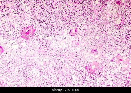 Nécrose liquefactive du cerveau humain, photomicrographe lumineux montrant la perte des contours cellulaires, l'accumulation de débris cellulaires, macrophages infiltratio Banque D'Images