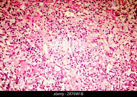 Nécrose liquefactive du cerveau humain, photomicrographe lumineux montrant la perte des contours cellulaires, l'accumulation de débris cellulaires, macrophages infiltratio Banque D'Images