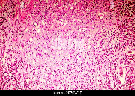 Nécrose liquefactive du cerveau humain, photomicrographe lumineux montrant la perte des contours cellulaires, l'accumulation de débris cellulaires, macrophages infiltratio Banque D'Images