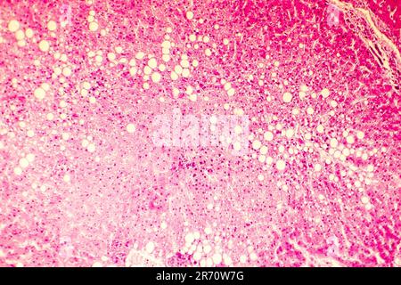 Foie gras, stéatose hépatique. Photomicrographe montrant de grandes vacuoles de graisse de triglycérides accumulées à l'intérieur des cellules hépatiques, il se produit dans la surconsommation d'alcool, Banque D'Images