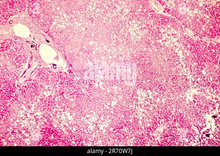 Foie gras, stéatose hépatique. Photomicrographe montrant de grandes vacuoles de graisse de triglycérides accumulées à l'intérieur des cellules hépatiques, il se produit dans la surconsommation d'alcool, Banque D'Images