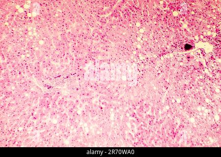 Foie gras, stéatose hépatique. Photomicrographe montrant de grandes vacuoles de graisse de triglycérides accumulées à l'intérieur des cellules hépatiques, il se produit dans la surconsommation d'alcool, Banque D'Images