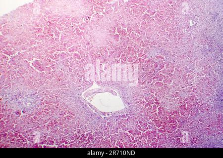 Congestion hépatique chronique, micrographe léger, congestion causée par une insuffisance cardiaque droite chronique Banque D'Images