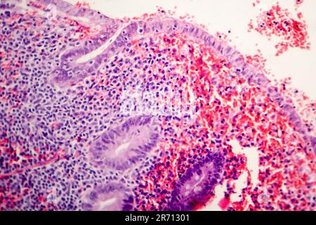 Histopathologie de l'appendicite chronique, micrographe léger, photo sous microscope Banque D'Images