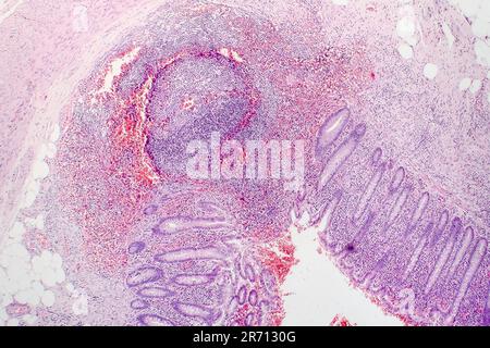 Histopathologie de l'appendicite chronique, micrographe léger, photo sous microscope Banque D'Images