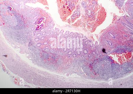 Histopathologie de l'appendicite chronique, micrographe léger, photo sous microscope Banque D'Images
