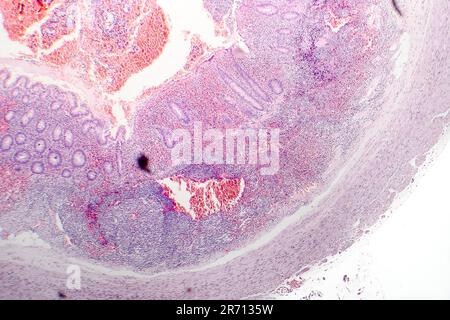 Histopathologie de l'appendicite chronique, micrographe léger, photo sous microscope Banque D'Images
