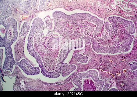 Adénocarcinome pulmonaire, micrographe léger, photo sous microscope Banque D'Images