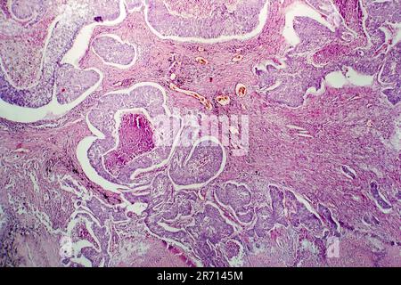 Adénocarcinome pulmonaire, micrographe léger, photo sous microscope Banque D'Images