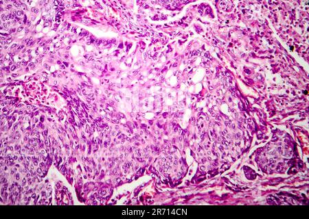 Adénocarcinome pulmonaire, micrographe léger, photo sous microscope Banque D'Images