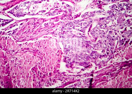 Adénocarcinome pulmonaire, micrographe léger, photo sous microscope Banque D'Images