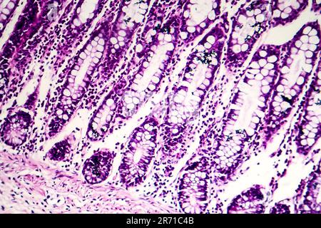 Dysenterie bacillaire, micrographe léger, photo sous microscope montrant la présence de bactéries et l'accumulation de cellules inflammatoires Banque D'Images