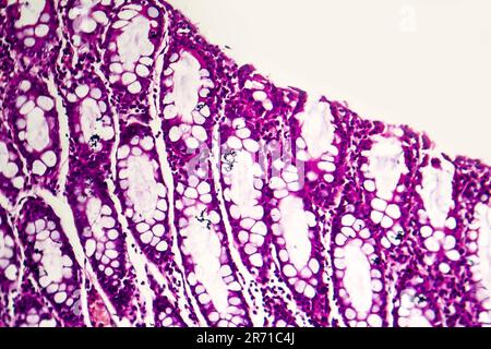 Dysenterie bacillaire, micrographe léger, photo sous microscope montrant la présence de bactéries et l'accumulation de cellules inflammatoires Banque D'Images