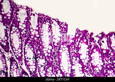 Dysenterie bacillaire, micrographe léger, photo sous microscope montrant la présence de bactéries et l'accumulation de cellules inflammatoires Banque D'Images